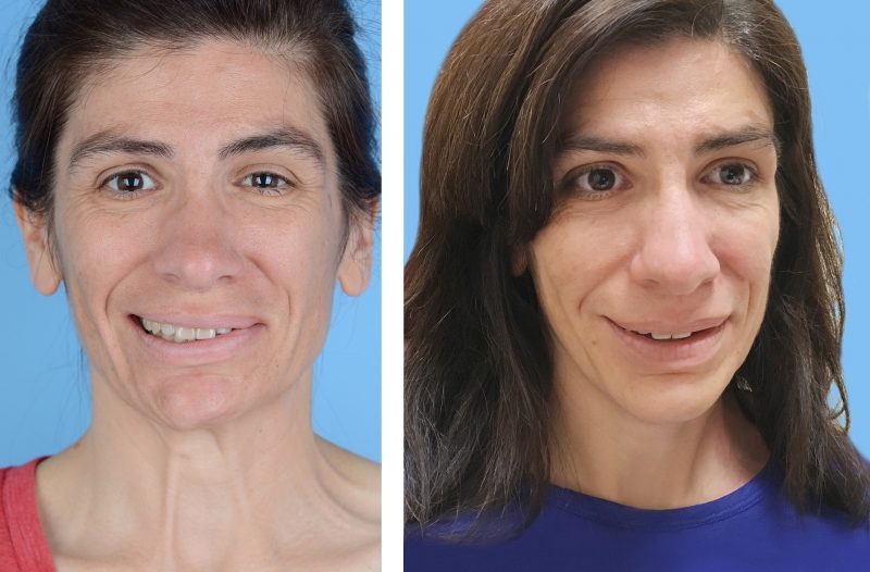 before-after-800x526-9225413