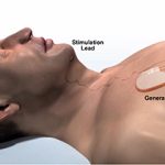 An illustration of upper airway stimulation, courtesy of Inspire Medical Systems, Inc