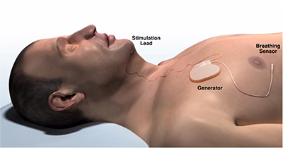 An illustration of upper airway stimulation, courtesy of Inspire Medical Systems, Inc