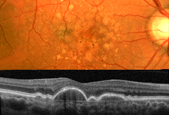 Age-related macular degeneration before and after photo