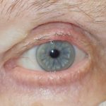 eyelid reconstruction
