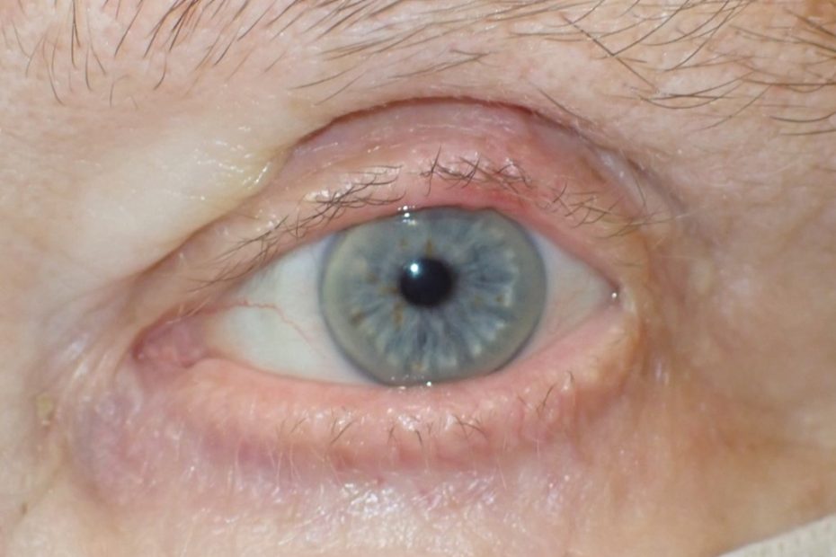 eyelid reconstruction