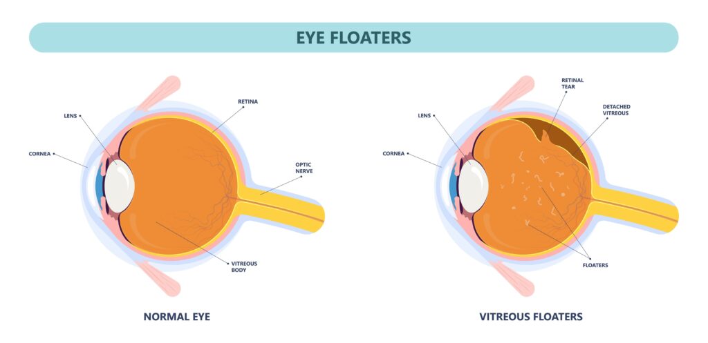 This diagram shows how a posterior vitreous detachment occurs.
