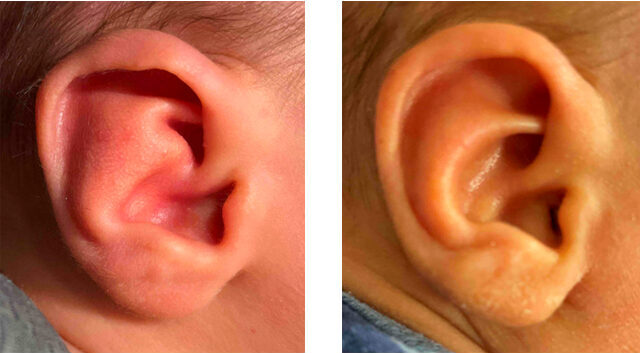 Before and after image: An infant before ear molding (left) and then post- ear molding, 18 days duration (right).