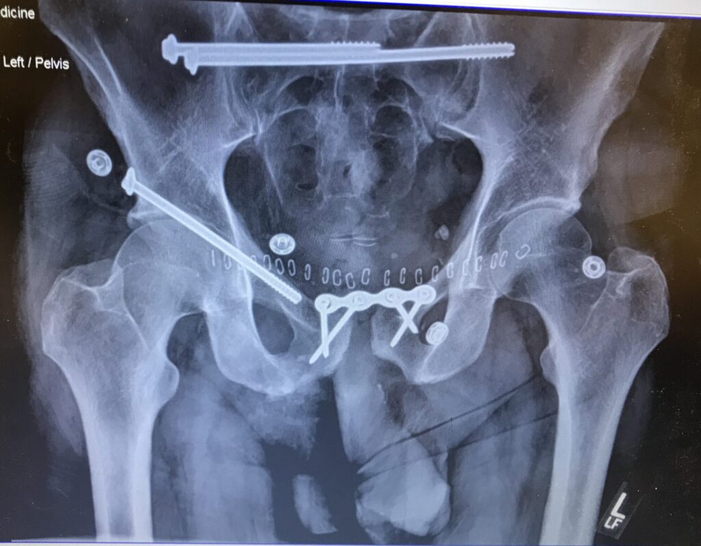An X-ray shows the pins and surgical repairs needed for Dan Kenney's shattered pelvis.