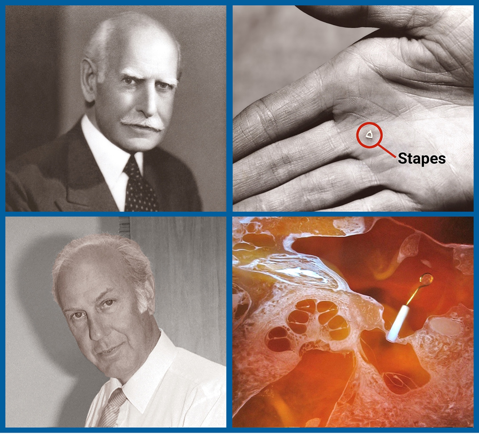 Four-panel photo: Dr. Frederick L. Jack (top left headshot) became the first doctor to perform a stapedectomy, by removing a small bone called the stapes as shown being held in the palm of a hand (top right), from the middle ear. Dr. Harold F. Schuknecht (bottom left headshot), developed a metal stapes prosthesis (bottom right) just 0.6 millimeters in the 1950s as seen in implanted in tissue in this surgical photo.