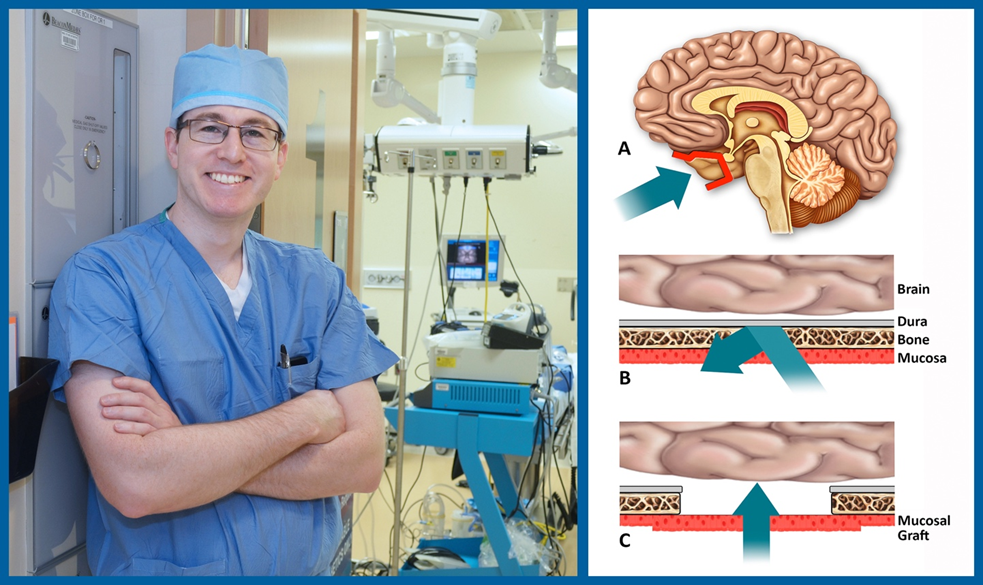 Dr. Benjamin Bleier, (left) in surgical scrubs, side by side with a graphic of three images depicting research on delivering drugs across the impenetrable blood-brain barrier (right). 